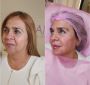Transform Your Look with Non-Surgical Full Face Treatment in