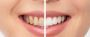 Cost of Teeth Whitening in Andheri, Mumbai