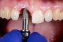 Best Dental Implant Treatment in Juhu, Mumbai