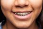 Affordable Orthodontics in Scottsdale – Book Your Consultati