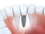 Dental Implants in Stockton – Trusted Specialists at NuSmile