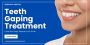 Teeth Gaping? Here’s How We Treat It in Indore!