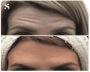 Smooth Away Wrinkles with Expert Botox in Leeds – Serenity A