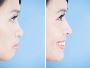 Chin Implant Surgery in San Francisco