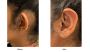 Ear plastic Surgery Cost in California