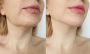 Neck Liposuction (NeckLipo) in 2025: Define Your Jawline and