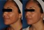 Stunning Results: Photofractional Laser Before and After