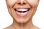 Porcelain Veneers Miami FL for a Perfect Smile