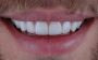 Perfect Your Smile with Veneers in Miami - Sharp Dentistry