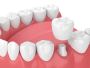 Dental crowns - AIMS Dentistry at Sheppard