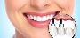 Restore Your Smile with Dental Implants – Reseda Experts