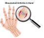 Comprehensive Arthritis Treatment in Tirunelveli: Expert Car