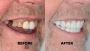 Effective Solutions on How to Fix Gap Teeth