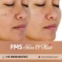 Effective Open Pores Treatment in Hyderabad | FMS Skin & Hai