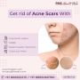 Acne Scars Treatments & What Really Works: A Comprehensive G