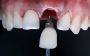 Best Dental Implant Parts Suppliers – Siiodent Implants