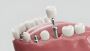 Siiodent Implants: Advanced SSI Conical Straight Implant