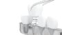 High-Quality Conical Micro Abutments | Siiodent Implants