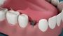 SSI Conical Straight Implant 0° Taper for Perfect Fit