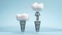 Looking for the Best Dental Implants Brands? Choose Siiodent