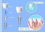 Siiodent Implants: Discover the Advantages of Hex Implants