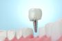 Siiodent Implants – Precision CoCr Abutment for Hex Implant 