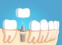 Your Partner for Dental Implant OEM Solutions in USA