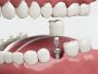 Perfect Fit & Strength: Angled Abutment for Conical Implant 