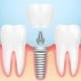 Your Partner in Advanced Dental Implant Solutions