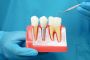 Best Conical Abutments Brands for Implant Success