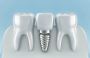 Affordable Dental Implant Components Wholesale for Clinics