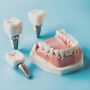 Shop the Best Conical Abutments for Your Practice