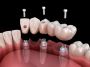  Find the Best Conical Abutments for Perfect Fit