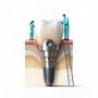 Affordable SSI Conical Straight Implant 6 Deg Taper