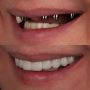 Best Conical Abutments for Secure Implant Support