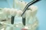 Multi Unit Abutments Ideal for All-On-4 Systems