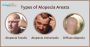 Effective Alopecia Areata Homeopathic Treatment in India