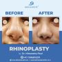 Nose Transformation: Expert Reshaping for a Confident You