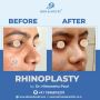 Expert Rhinoplasty in Chandigarh - Enhance Your Facial.