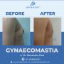 Effective Gynecomastia Surgery Near You in Chandigarh