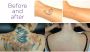 hair removal hair removal
