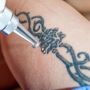 Permanent Tattoo Removal Treatment in Mumbai: Unleash Your C
