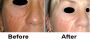 Transform Your Skin with CO2 Fractional Laser at Dr. Mahavee