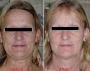 Effective Non-Surgical Skin Tightening Solutions in Dubai