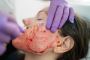 Vampire Facial Treatment in Indore: For Radiant Skin.