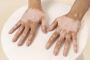 Vitiligo Treatment in Indore: Safe and Personalized Solution