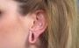 Earlobe Repair treatment in Delhi - Lobuloplasty at Skinolog