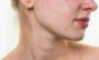 Acne Vulgaris treatment in Delhi Get Clear and Glowing Skin