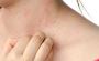 Best urticaria treatment in Delhi