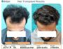 Advanced Hair Transplant Surgery in Delhi by Experienced 